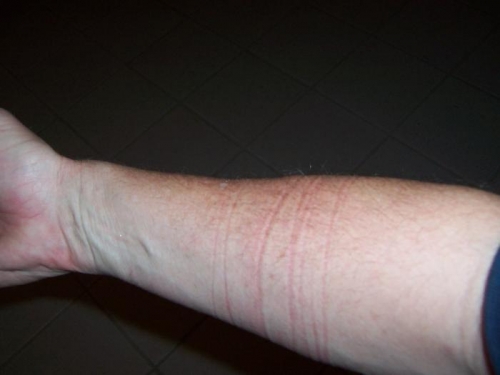 It goes away next day except bruising marks.